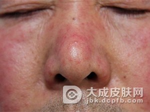 酒渣鼻早期治疗方法