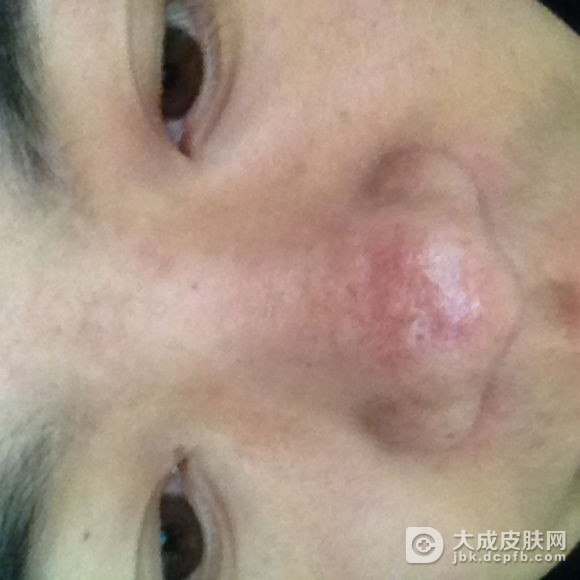 酒渣鼻患者正确的洗脸方法