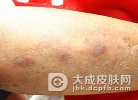 传染性红斑的症状有什么特点