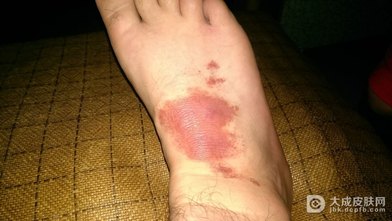 过敏性紫癜不能吃以下食物