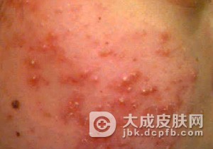不是青春期为什么长青春痘
