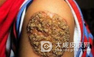 瘰疬性皮肤结核病的鉴别诊断