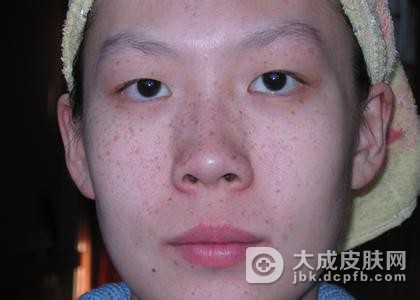 雀斑有哪些症状？