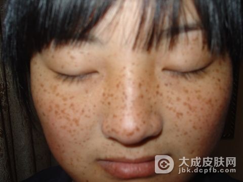 雀斑出现的原因是什么？