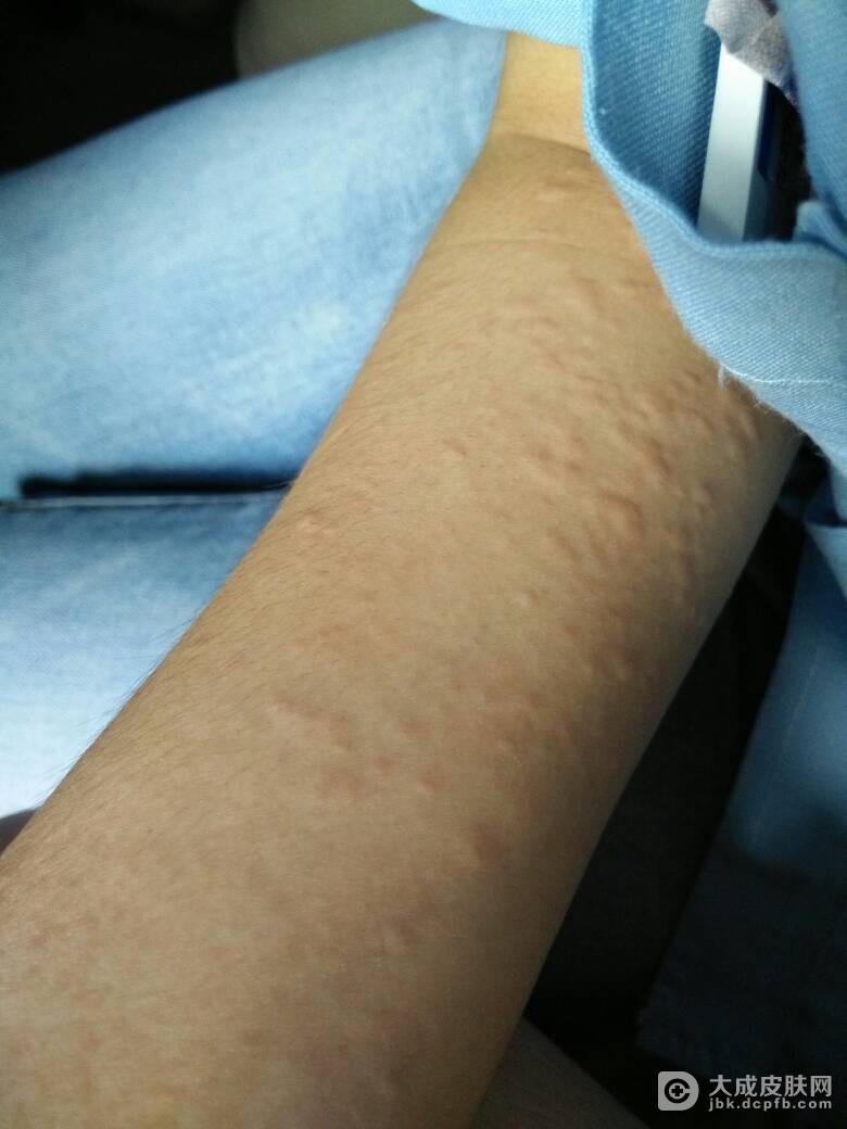 急性荨麻疹的病因有哪些