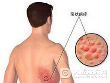 带状疱疹:这种病叫“缠腰龙” 据说缠满一圈会出大问题