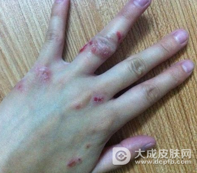 秋天湿疹多发 湿疹是怎么引起的