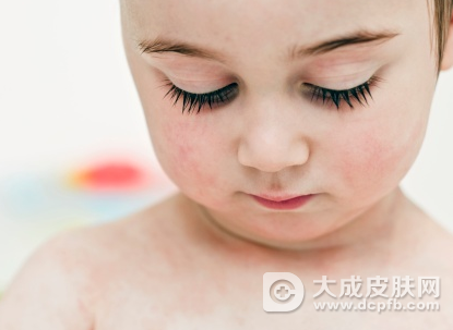 揭秘儿童特应性皮炎的遗传性