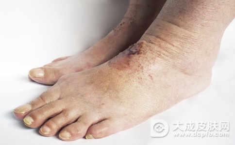 简单治疗脚气脚痒的方法 用它泡屡试屡爽