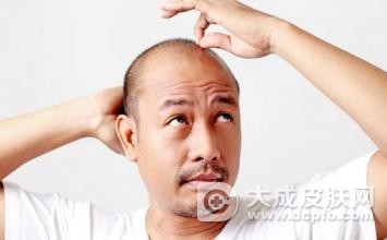 男性前额头发少怎么办 经常掉头发是什么原因