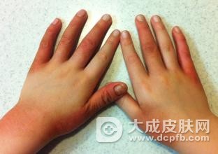 湿疹性皮炎怎么治 常用湿疹偏方大全