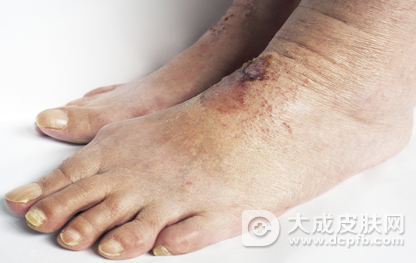 脚气会传染到手上吗 脚气脱皮痒怎么办