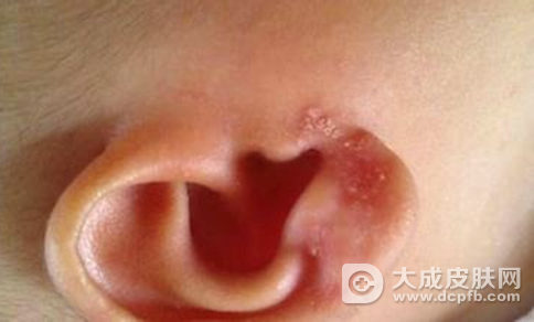 外耳道湿疹什么症状 速识别尽早治愈