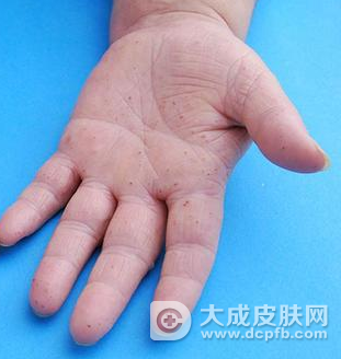 患有水泡型湿疹怎么办 水疱型湿疹怎么治