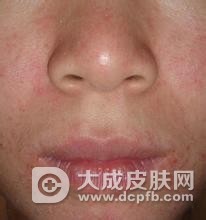 成人脸上湿疹怎么办 注意预防和治疗
