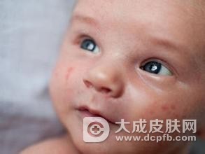 婴儿湿疹该怎么办呢 婴儿湿疹的治疗方法