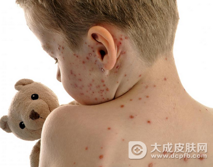 小儿湿疹是怎么引起 小儿湿疹的治疗方法