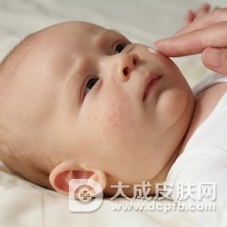 宝宝得了湿疹怎么办 秋季宝宝湿疹护理
