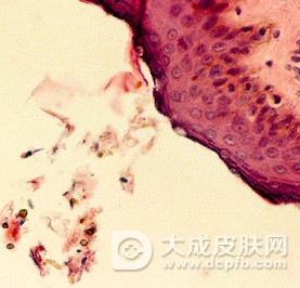 治疗花斑癣的注意事项是什么 治疗花斑癣用什么药