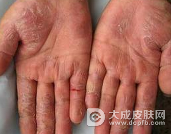 湿疹加重是由哪些原因导致的呢