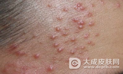额头长毛囊炎痘痘怎么办