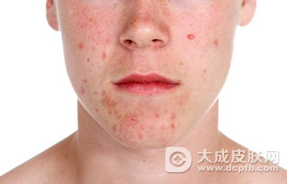 皮肤长粉刺怎么办
