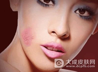 脸上有红血丝怎么办 红血丝的去除方法