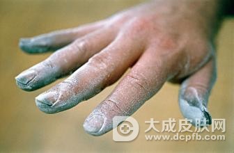 灰指甲会遗传吗 灰指甲患者日常怎样护理