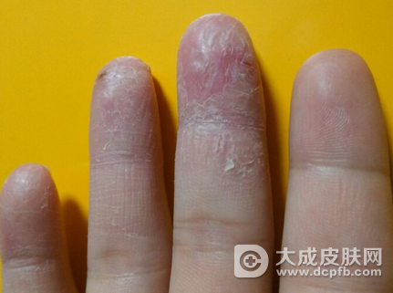 手指脱皮是怎么回事 手指脱皮怎么护理