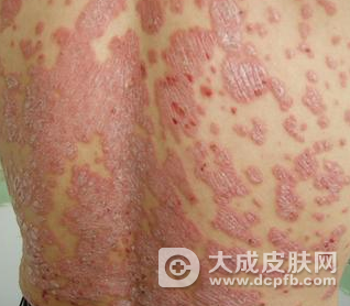 牛皮癣是怎么引起的 牛皮癣日常注意事项