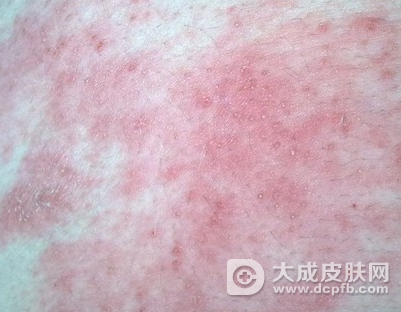 过敏性皮炎怎么治