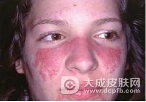 面部脂溢性皮炎有哪些症状 脂溢性皮炎怎么护理