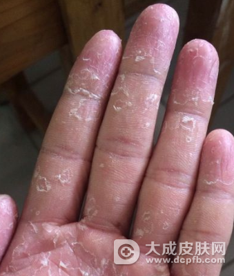 手癣会传染给宝宝吗 怎样治疗手癣