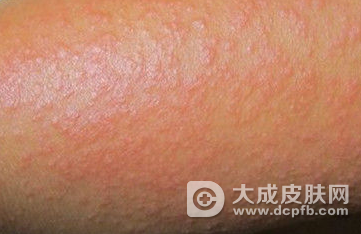 多事之秋:预防秋季高发的几种皮肤病