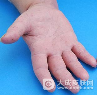 手指起水疱性湿疹怎么治