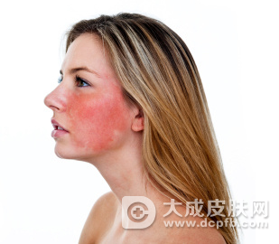 怎样去除红血丝呢 护理面部红血丝最管用的方法
