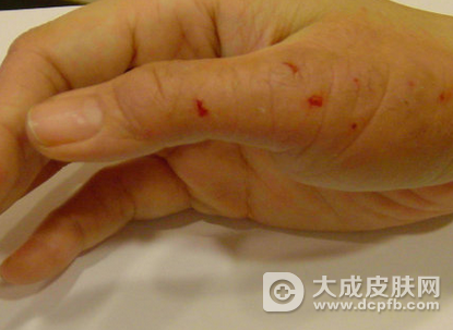 怎么治疗过敏性皮炎 过敏性皮炎的症状是什么