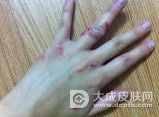 秋季湿疹的家庭护理方法有哪些