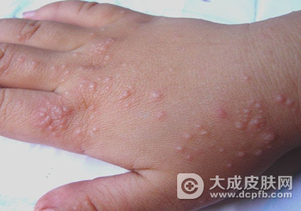 得了湿疹怎么办 调护得当是关键