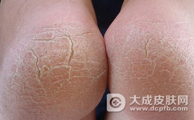 脚脱皮是怎么回事 如何治疗脚脱皮