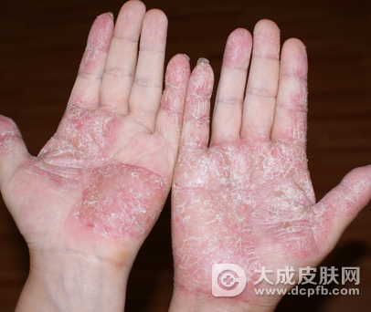 手上有手癣鹅掌风怎么办 