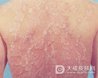患上银屑病怎么办 专家提醒别过度治疗