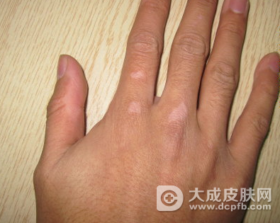 怎么预防白癜风