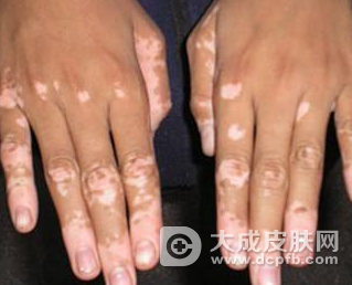 白癜风怎么护理