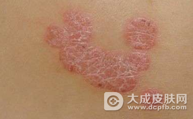 专家解答银屑病患者的