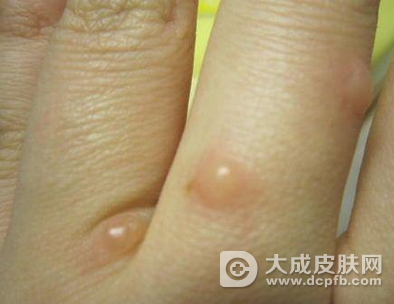 湿疹水泡怎么处理 湿疹的药物治疗方法 