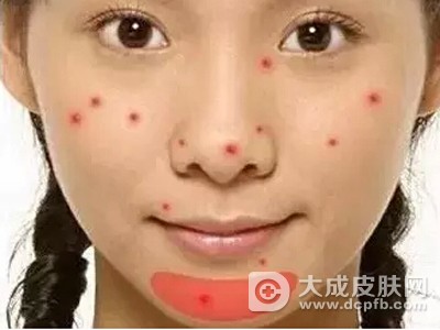 下巴鼻子长痘痘是什么原因 下巴鼻子长痘痘怎么办
