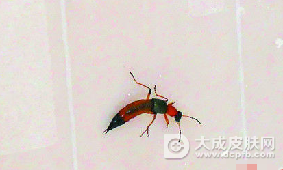 广东新桥中学飞来隐翅虫 学生被叮咬致皮肤感染