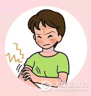 患特应性皮炎怎么办 及时治疗能保命