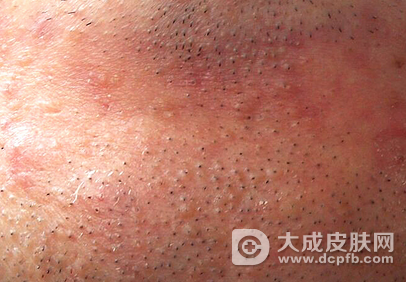 中医去除毛囊炎的方法有哪些呢